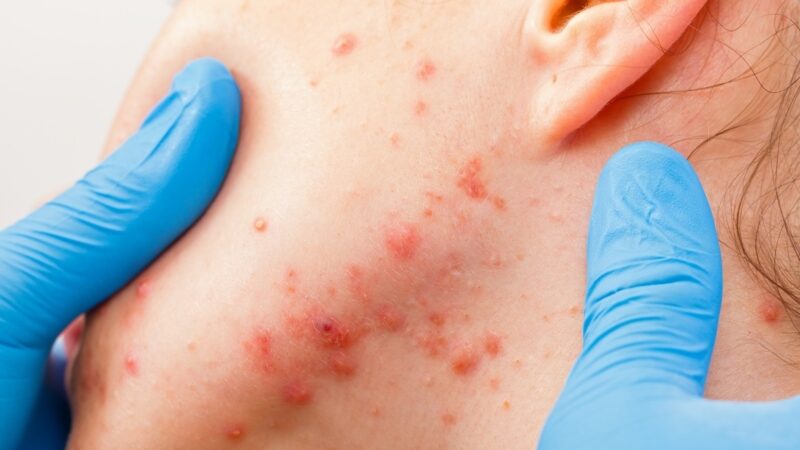 Controle de acnes na adolescência pode ser feito com alimentação saudável