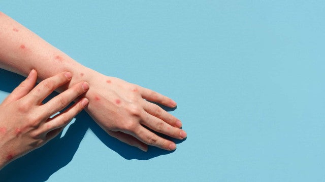 Varíola dos macacos: Saúde vai começar a vacinar dia 13