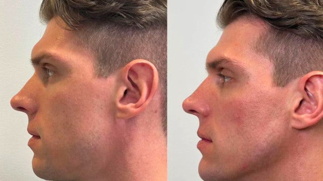 Cristian Vanelli, ex-BBB 23, faz harmonização facial com médico de Bruno Gaga