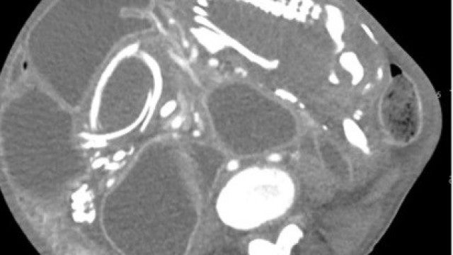 Mulher morre após ter feto no corpo durante 9 anos. Recusou operação