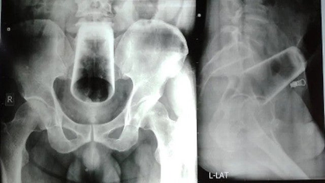 Homem bêbado insere copo no ânus e é preciso cirurgia para retirá-lo