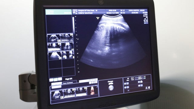 Caso raro no Paquistão: Bebê nasce com dois pênis e sem ânus