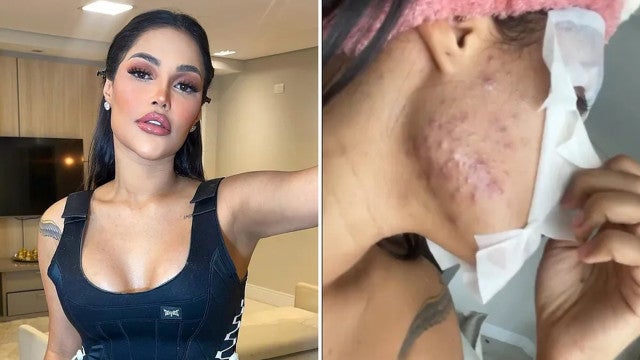 Flay diz que ganhou 10 kg e espinhas com ‘chip da beleza’: ‘Foi o chip da feiura’