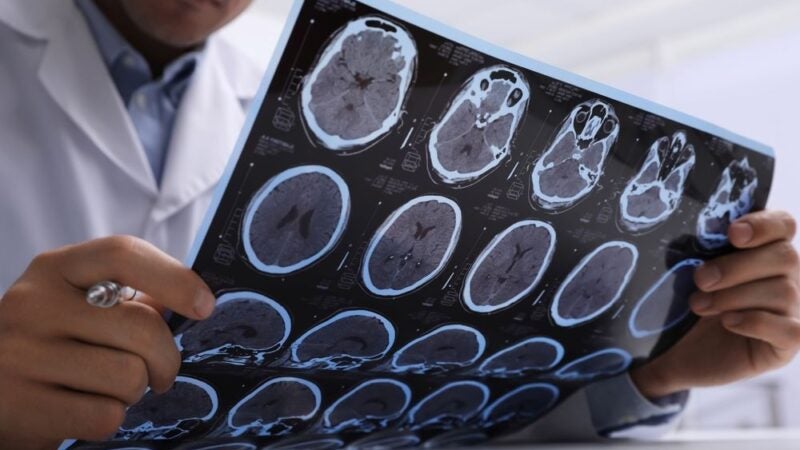 Esclerose Múltipla: O que é e como diagnosticá-la?