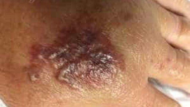 Mulher amputa perna após ser picada por aranha ‘inofensiva’ na Austrália