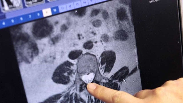 Remédio para câncer de tireoide terá cobertura obrigatória de planos de saúde