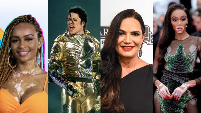 Famosos que têm vitiligo e superaram o preconceito