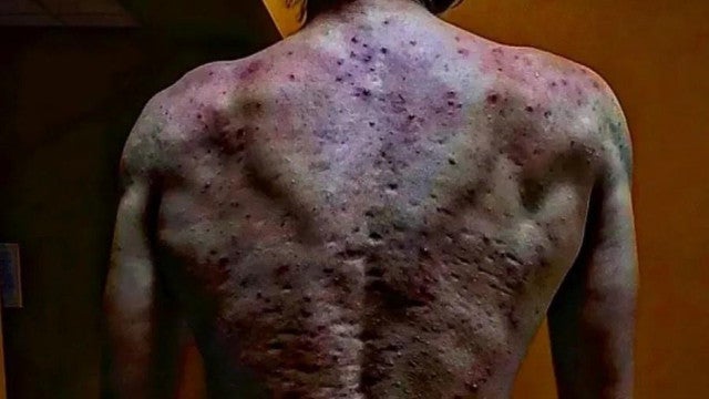 Jovem toma anabolizante e fica com quadro grave de acne