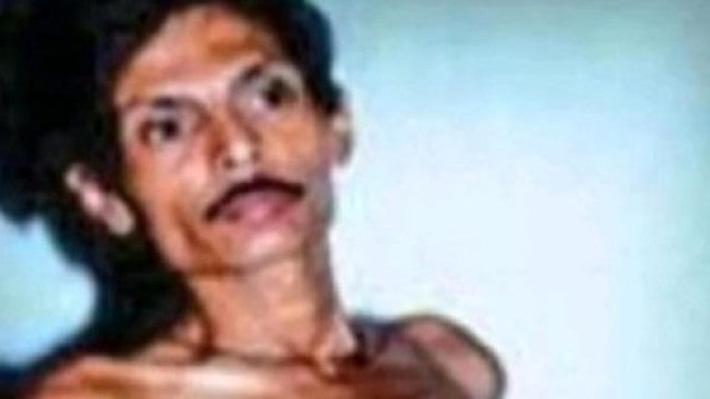 A história de Sanju, que esteve ‘grávido’ do irmão gêmeo durante 36 anos