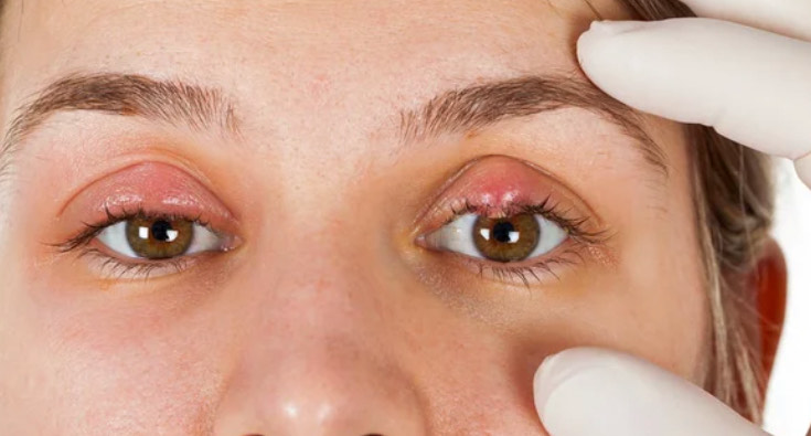 Calázio, terçol… quando operar? Oftalmologista Luiza Paulo Filho esclarece principais dúvidas