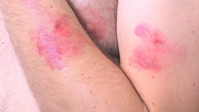 Casos de sarna são identificados em jovens da Fundação Casa em SP