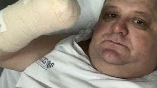 Humorista tem mão amputada após acidente com fogos de artifício em SC