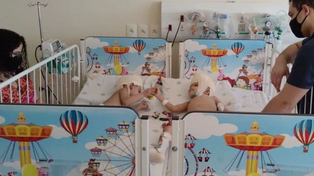 Gêmeas que passaram por cirurgia de separação recebem alta de CTI