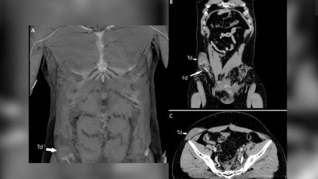 Testículo de homem é deslocado para o abdômen após acidente de moto