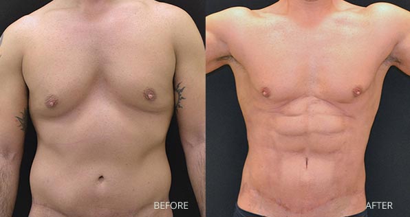 Abdominoplastia Masculina: Cada vez mais procurada pelos homens