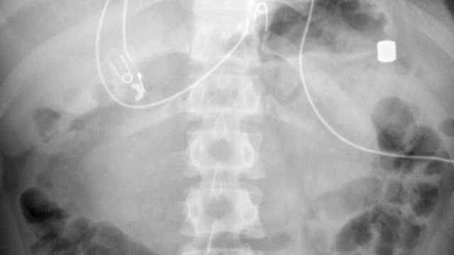 Adolescente com fortes "cólicas" tinha 21 ímãs no estômago e intestinos