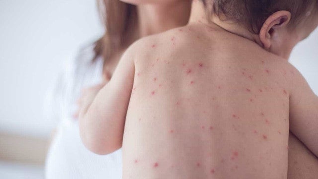 OMS alerta para aumento significativo de casos de sarampo na Europa