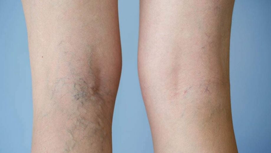 Calor aumenta incômodo com varizes: saiba como amenizar sintomas