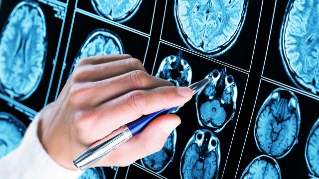 Planos de saúde querem propor mudança no rol para tratamento de autismo