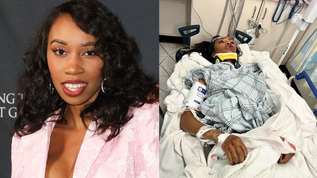 Atriz da Marvel sofre grave acidente e fica desfigurada