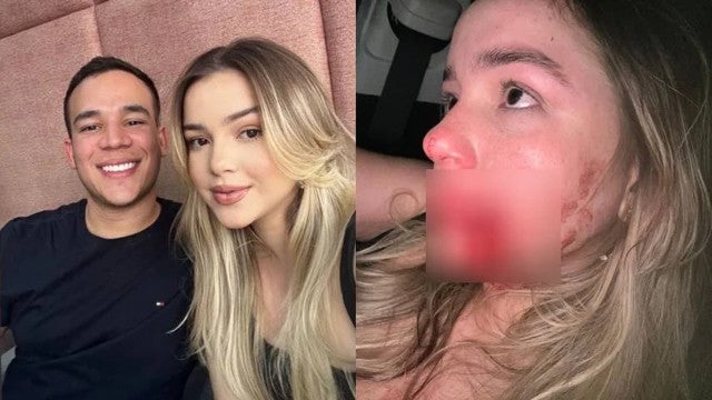 Modelo leva soco de síndico e fica com buraco no rosto