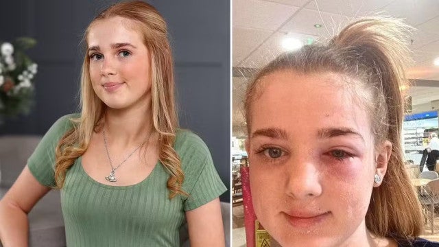 Adolescente quase ficar cega após seguir dicas de beleza do TikTok