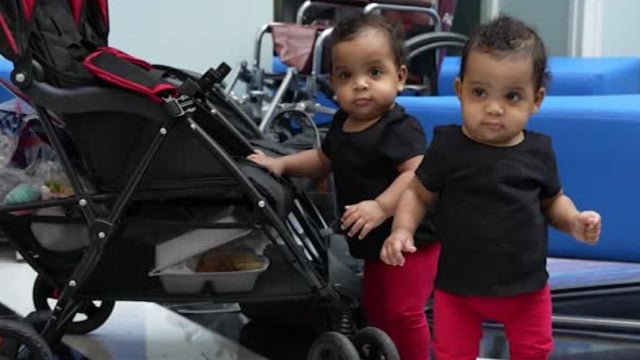 Gêmeas siamesas separadas há um ano vivem vida normal; veja como estão