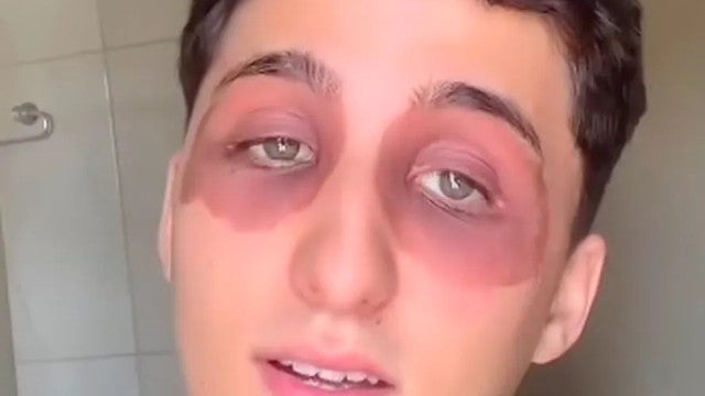 Jovem acorda com manchas e inchaço nos olhos e intriga a web