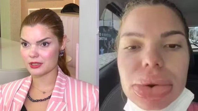 Nutricionista relata complicações após preenchimento labial