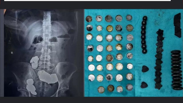 Homem engole moedas e Ímãs acreditando em aumento de massa muscular