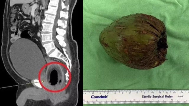 Cirurgiões removem coco verde de 9 cm do ânus de homem em Taiwan
