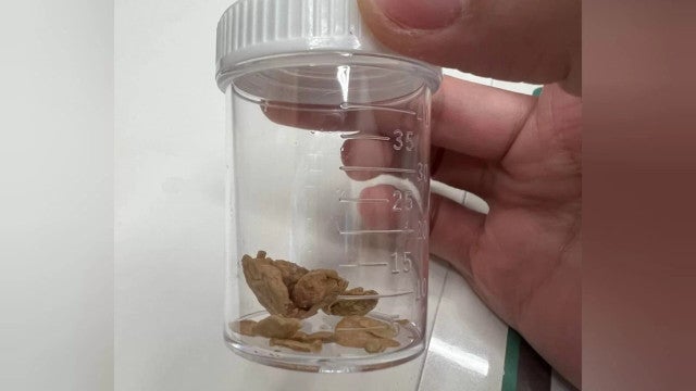 Caso chocante: homem forma pedras no pênis por falta de higiene