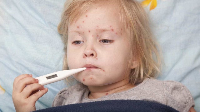 São Paulo fica sem vacina para a 2ª dose contra a catapora