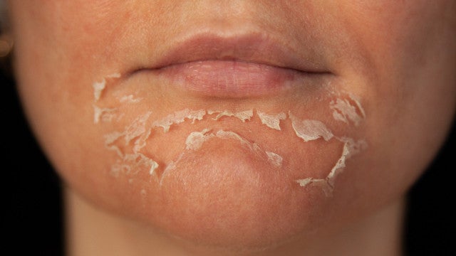 Mulher sofre queimaduras graves após peeling de fenol no PR