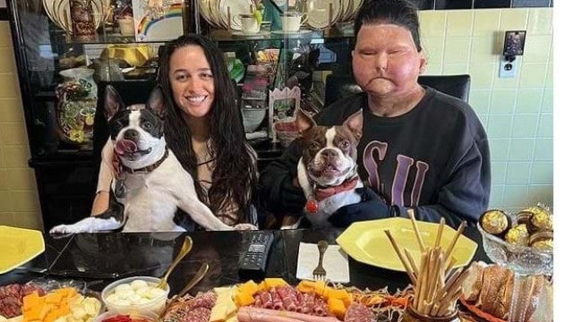 Jovem com transplante de rosto e mão encontra amor após acidente