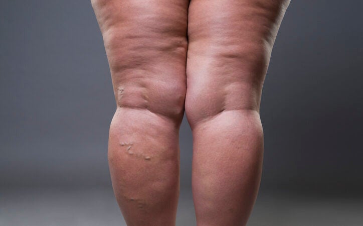 Linfedema e lipedema: qual é a diferença?