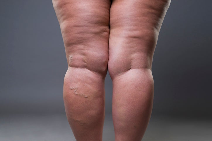 Linfedema e lipedema: qual é a diferença?