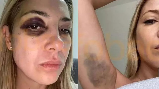 Ex-primeira-dama da Argentina mostra hematomas após agressão de Fernández
