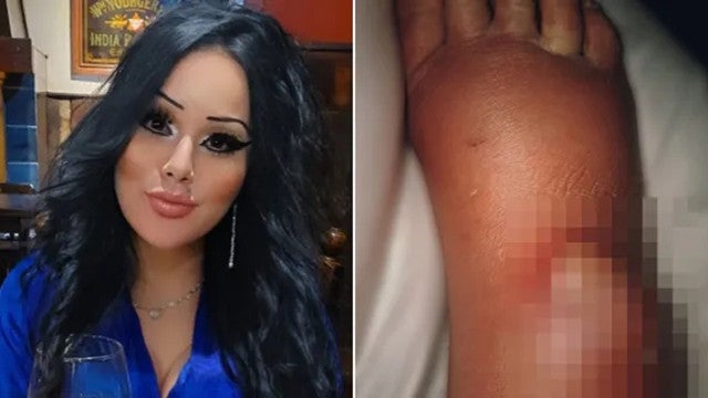 Reino Unido: Mulher quase tem perna amputada após ser picada por aranha