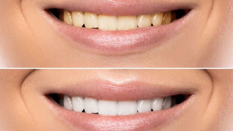 Clareamento dental caseiro sem supervisão profissional pode afetar a saúde bucal