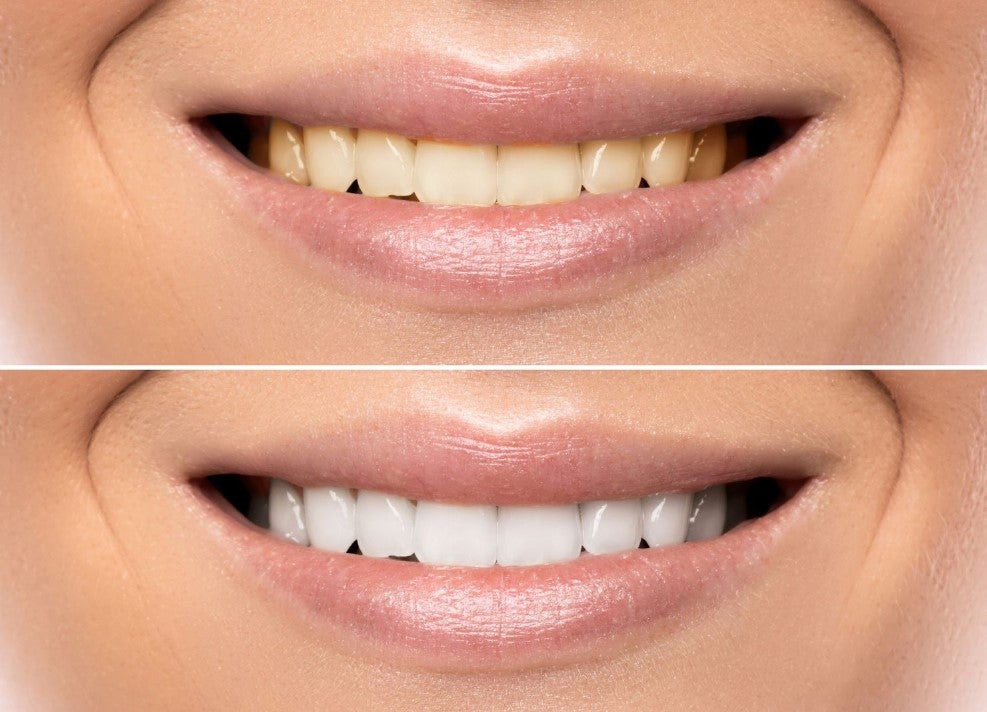 Clareamento dental caseiro sem supervisão profissional pode afetar a saúde bucal