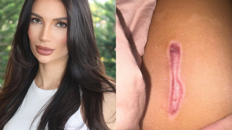 O papel dos bioestimuladores de colágeno no tratamento de cicatrizes