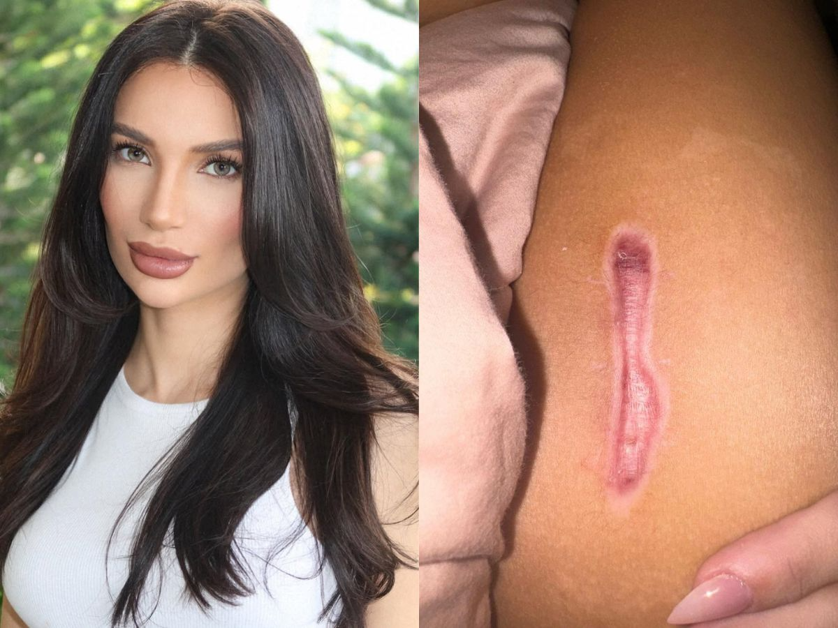 O papel dos bioestimuladores de colágeno no tratamento de cicatrizes